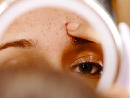 DECODING SKIN CONGESTION | HOW TO GET CLEAR SKIN - IORA India